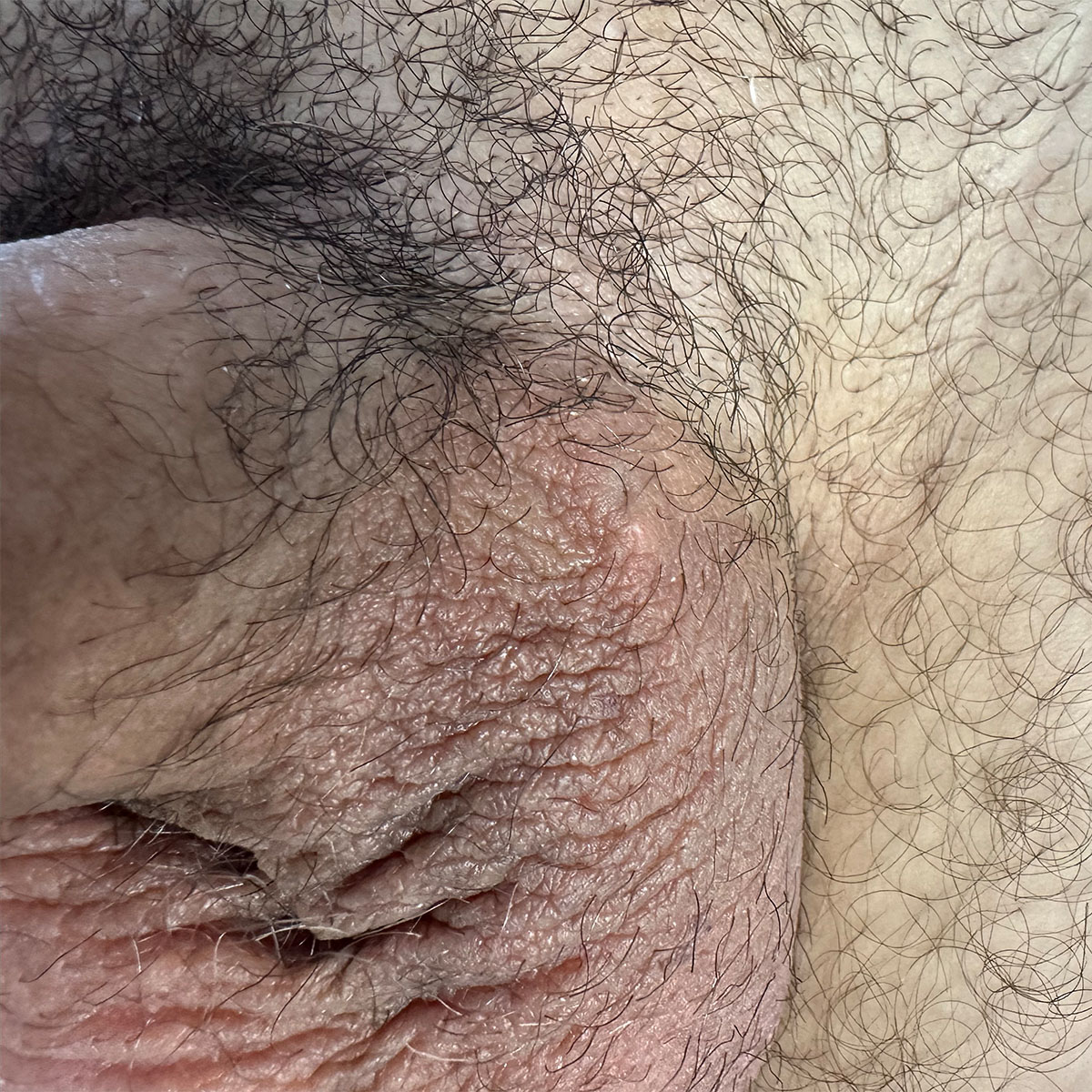 Varicocele micorchirurgico. Risultato a 1 mese