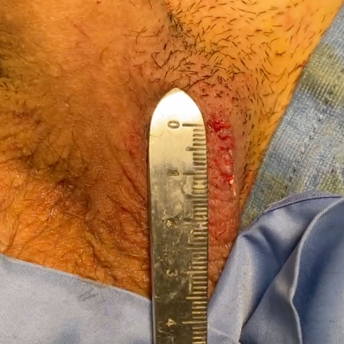Varicocele microchirurgico. Risultato finale